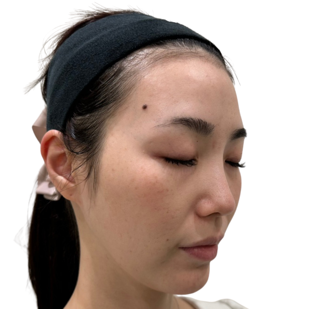 医療脱毛