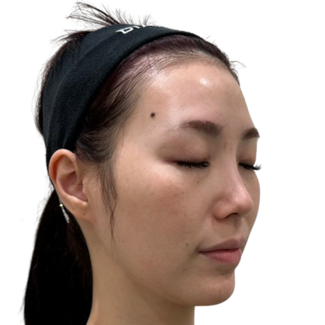 医療脱毛