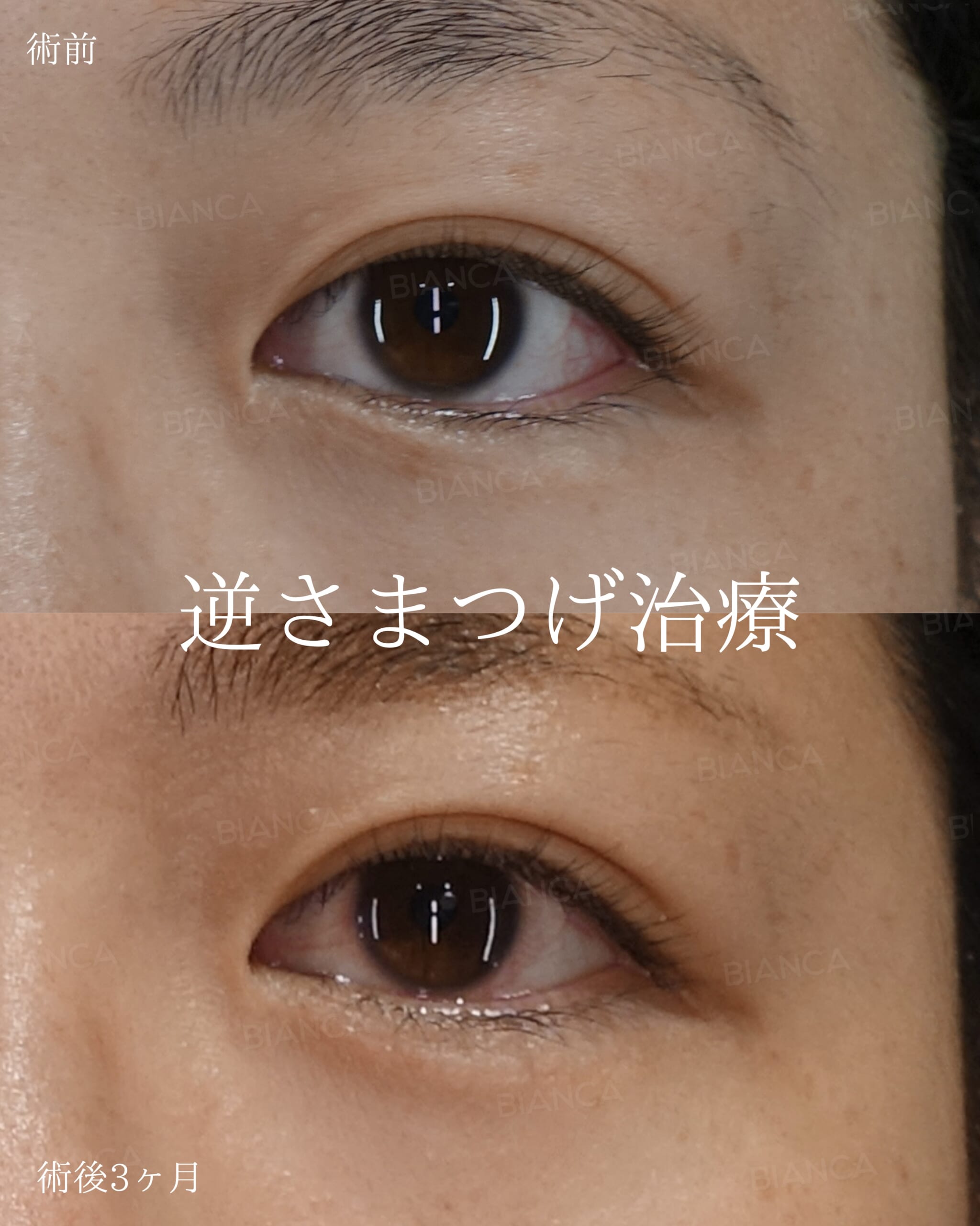 逆さまつげ