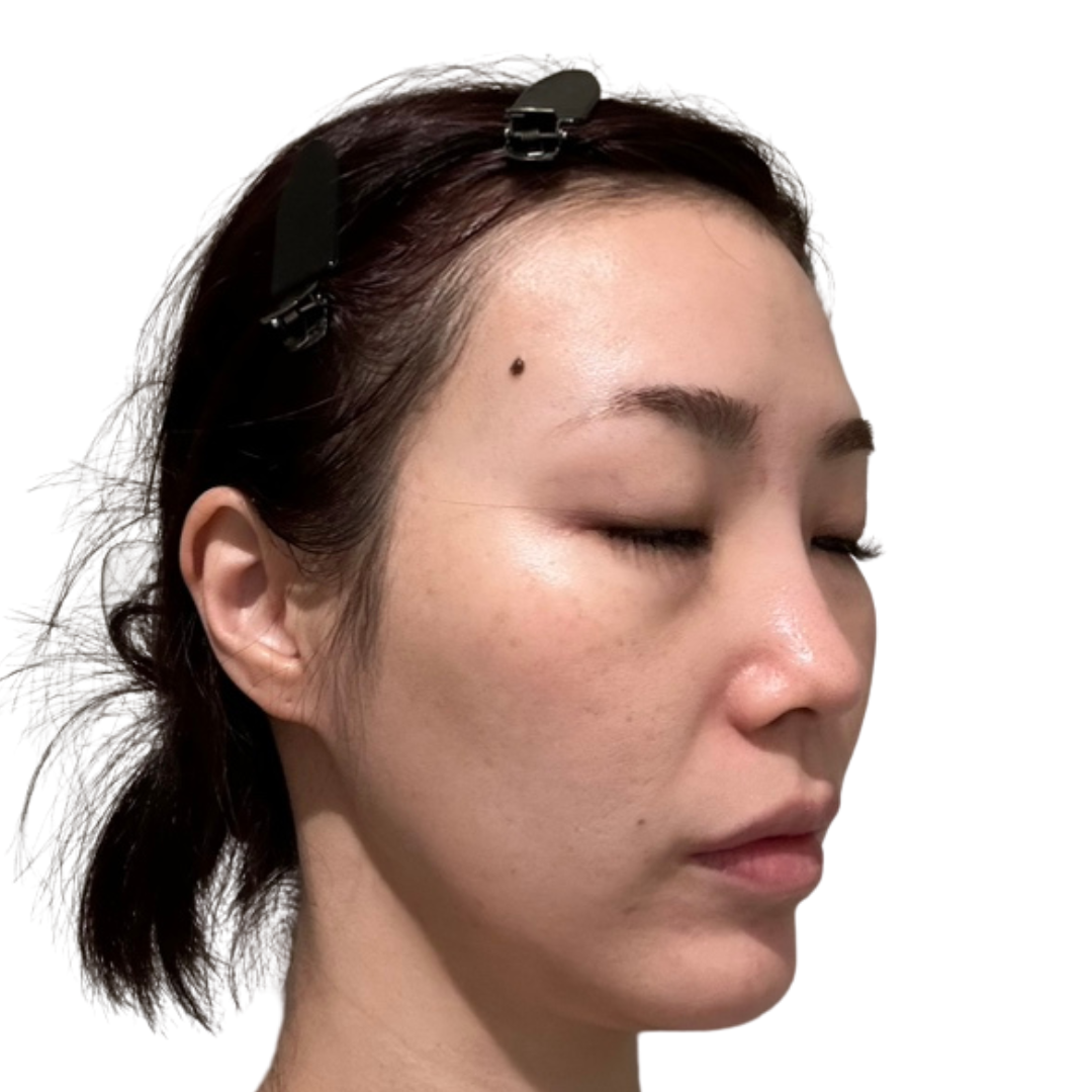医療脱毛