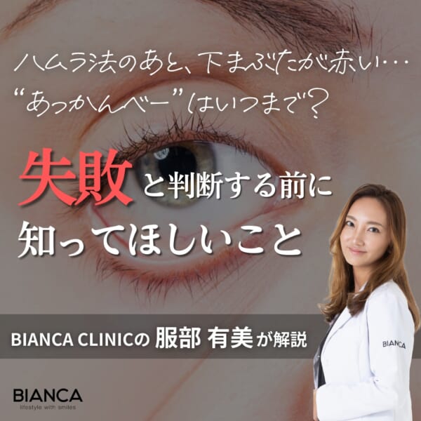 ハムラ法で目元が“あっかんべー”に？術後の変化と回復のポイントを専門医が解説 銀座・表参道にあるBIANCA CLINIC ビアンカクリニック｜美容外科・美容皮膚科・再生医療・美容婦人科・美容内科
