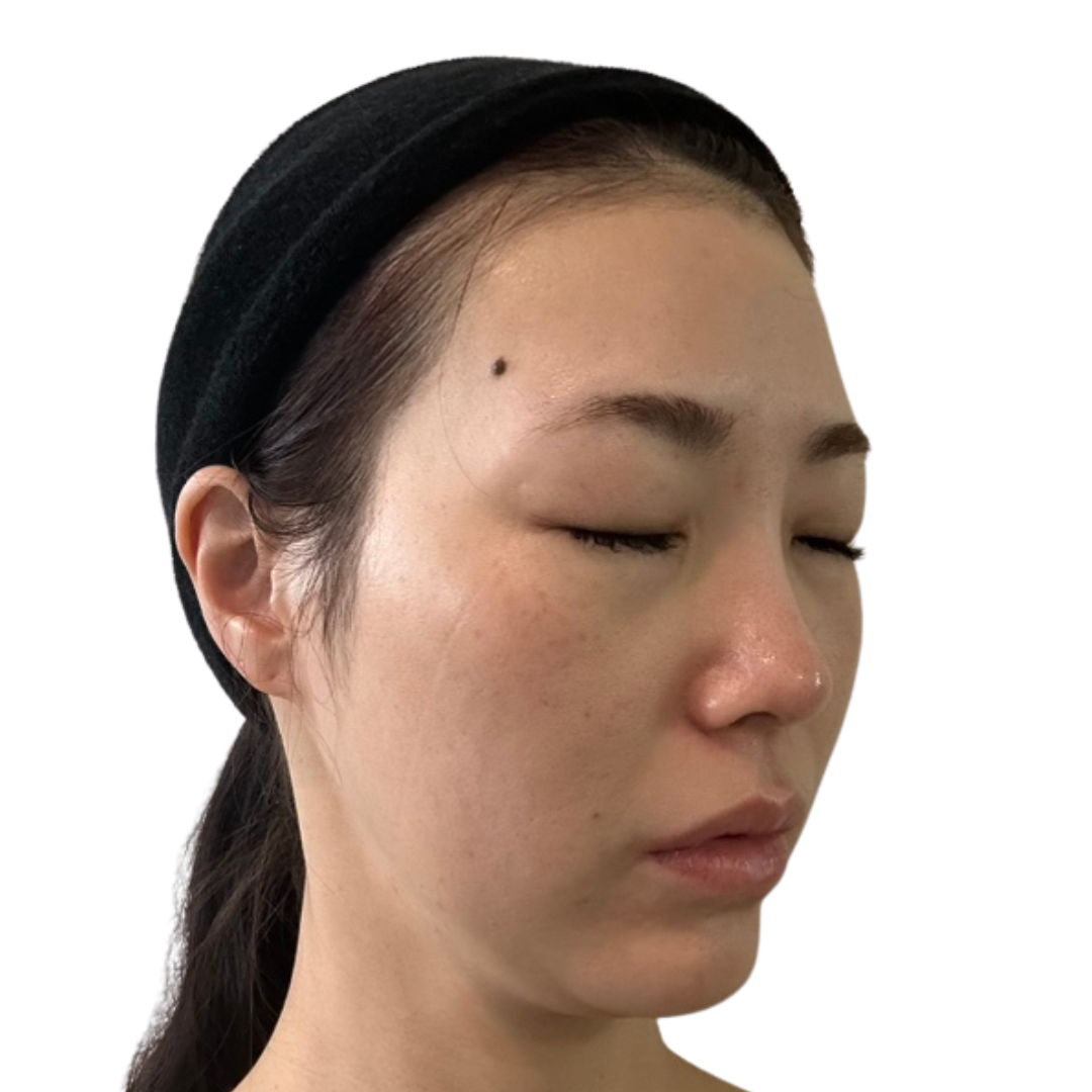医療脱毛