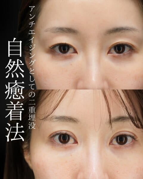 自然癒着法 銀座・表参道にあるBIANCA CLINIC ビアンカクリニック｜美容外科・美容皮膚科・再生医療・美容婦人科・美容内科