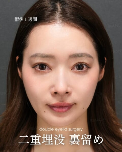 二重埋没 裏留め 銀座・表参道にあるBIANCA CLINIC ビアンカクリニック｜美容外科・美容皮膚科・再生医療・美容婦人科・美容内科