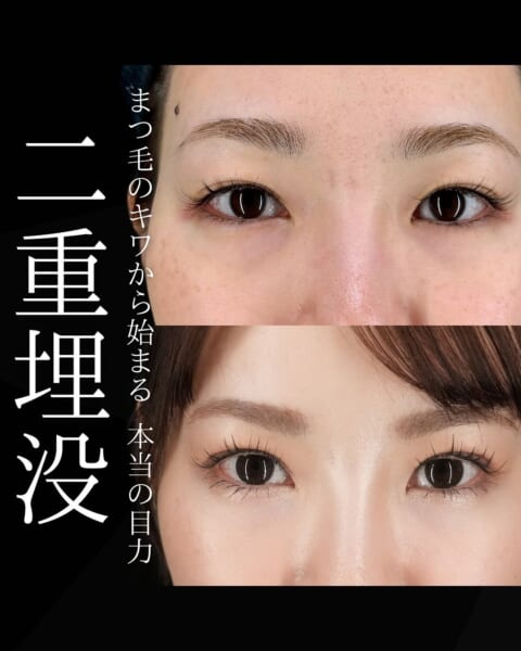 二重埋没 銀座・表参道にあるBIANCA CLINIC ビアンカクリニック｜美容外科・美容皮膚科・再生医療・美容婦人科・美容内科