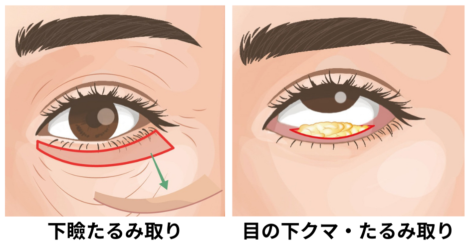 「下瞼たるみ取り」と「目の下クマ・たるみ取り」の違い<br />
