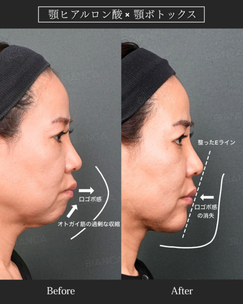 理想的な顎の形態｜美しい輪郭に欠かせない重要な要素｜ビアンカ銀座｜日本を代表する美容健康再生医療のクリニック