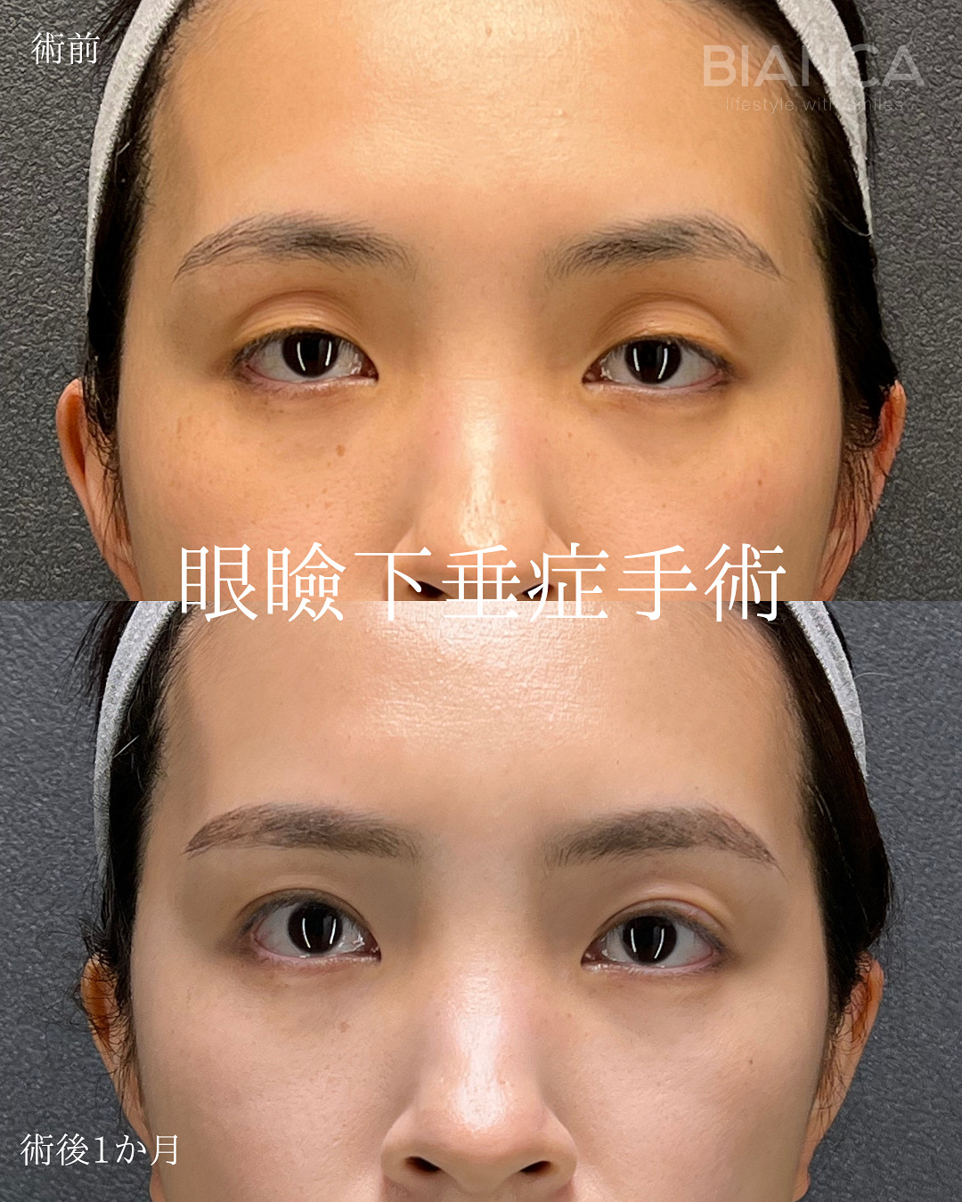 眼瞼下垂切開法