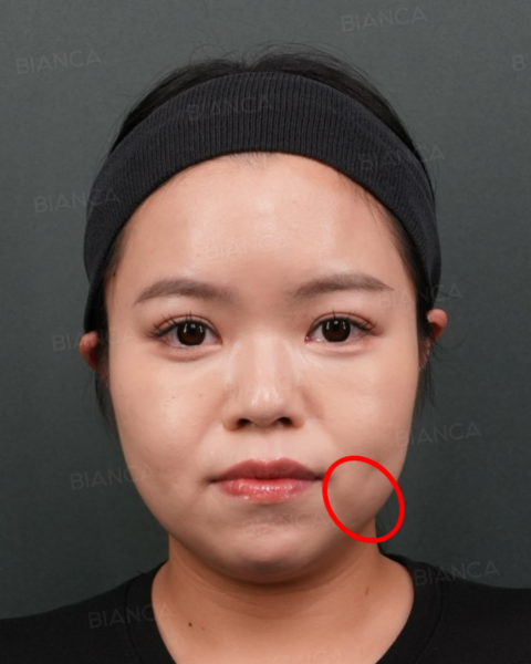 口横のもたつき・たるみの原因と治療法|ジョールファットとは|ビアンカ銀座|日本を代表する美容健康再生医療のクリニック