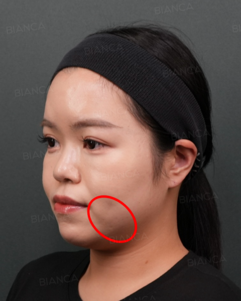 口横のもたつき・たるみの原因と治療法|ジョールファットとは|ビアンカ銀座|日本を代表する美容健康再生医療のクリニック
