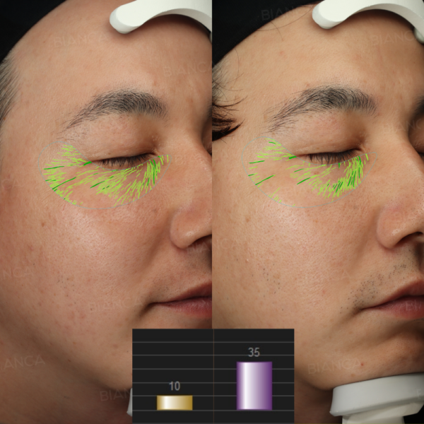 ナノステム(顔)|銀座・表参道にあるBIANCA CLINIC ビアンカクリニック|美容外科・美容皮膚科・再生医療・美容婦人科・美容内科・医療アートメイク