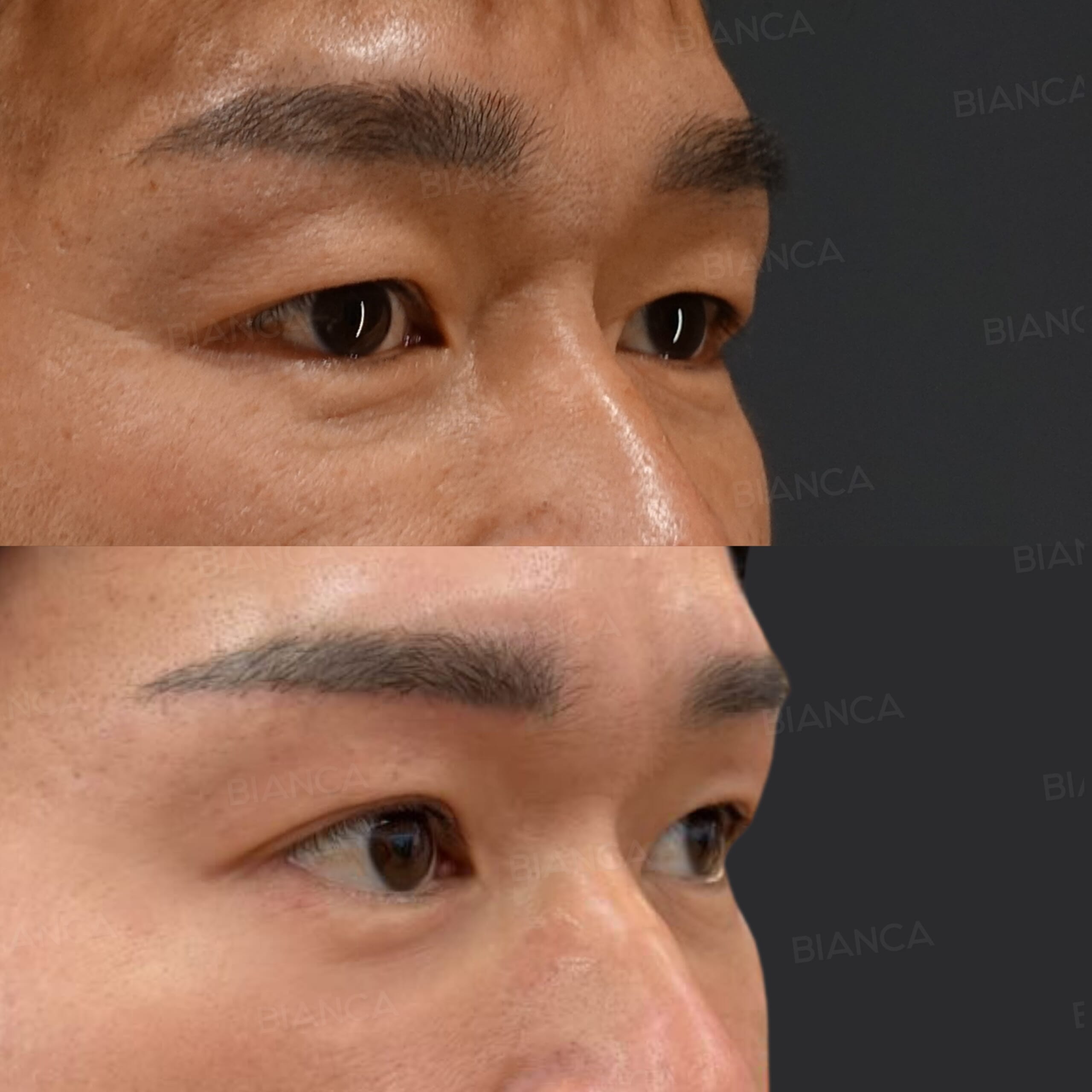 眉下切開