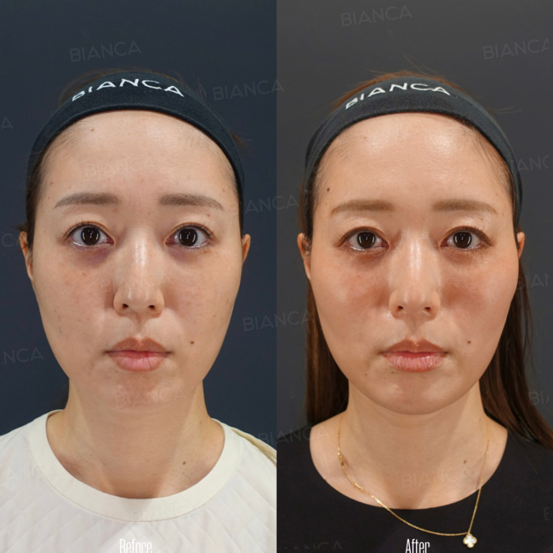 BIANCA LIFT
