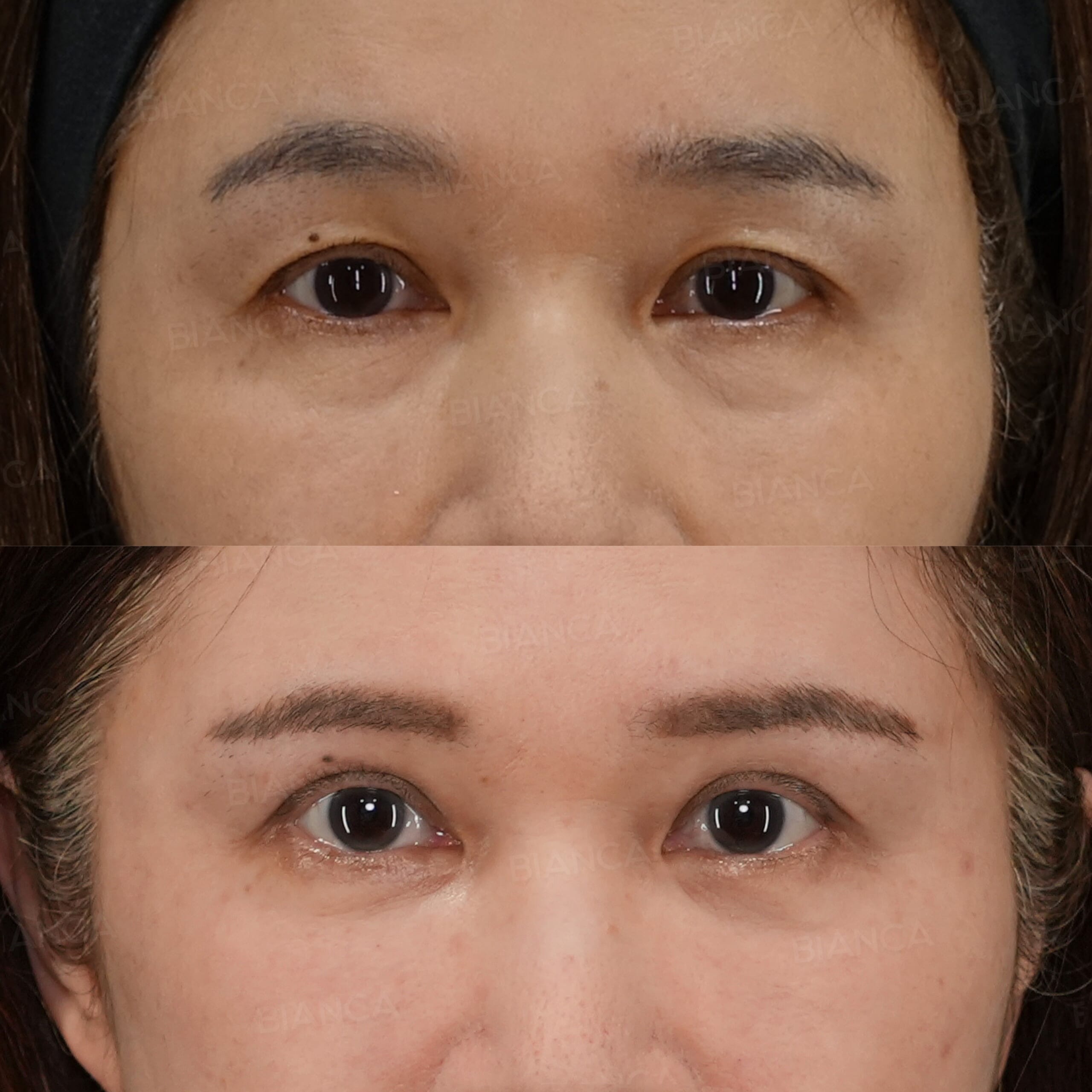 眉下切開、裏ハムラ法