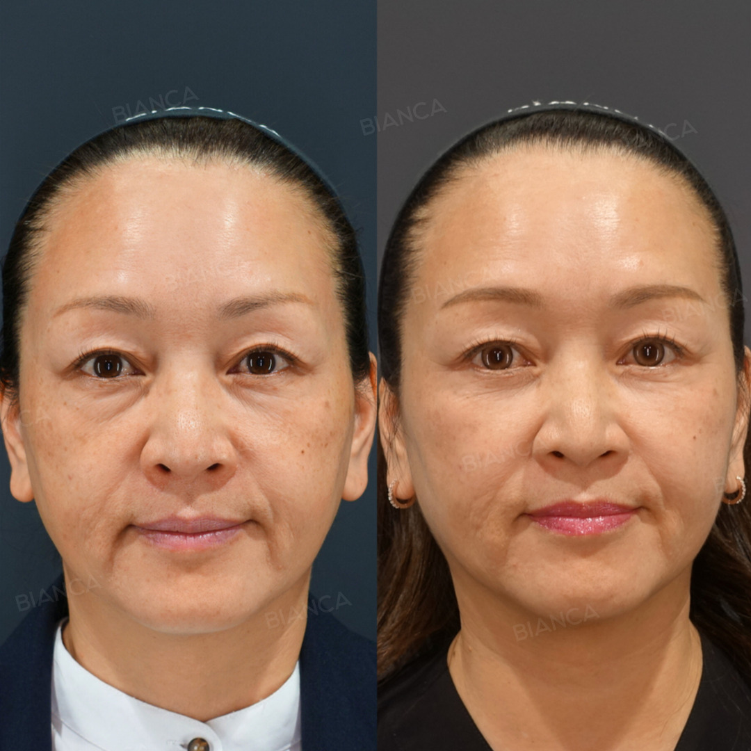 BIANCA CLINIC ビアンカクリニックのミッドフェイスリフト 症例写真