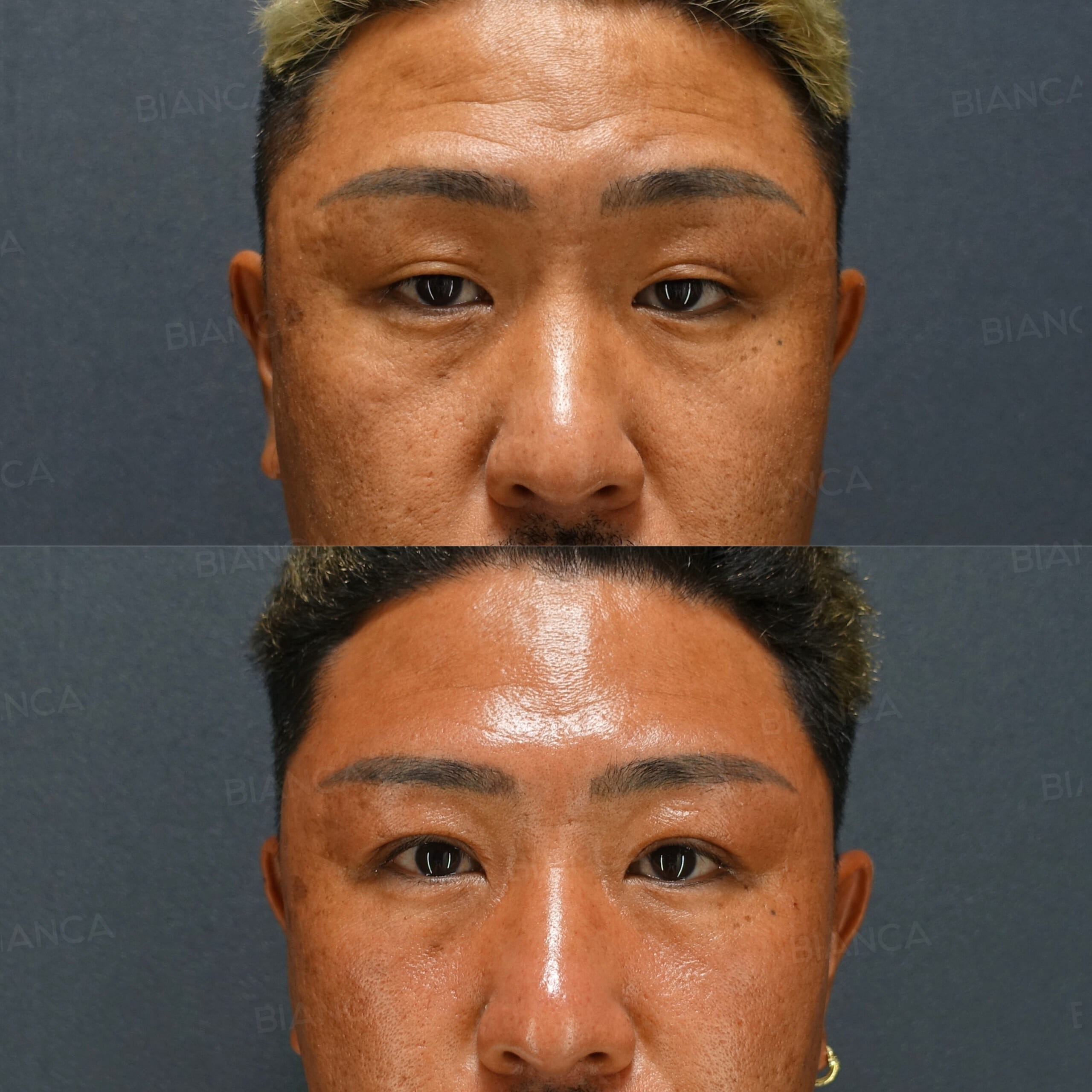 眼瞼下垂切開法