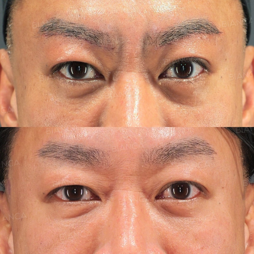 目の下クマ・たるみ取り 脂肪注入（目の下）