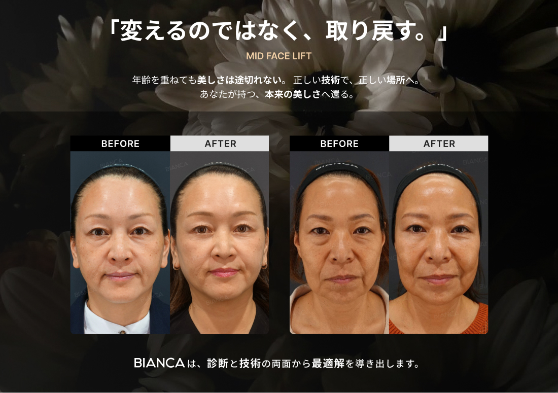 BIANCA CLINIC ビアンカクリニックのミッドフェイスリフト 症例写真