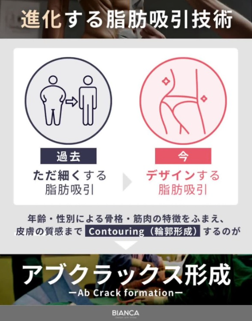 肌の質感が保たれた魅せる腹筋形成術<br />
