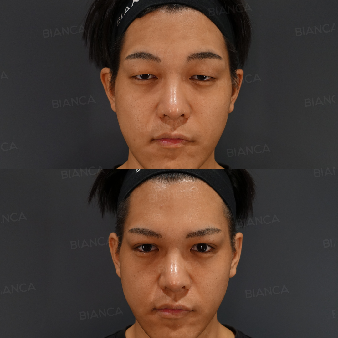 眼瞼下垂切開法