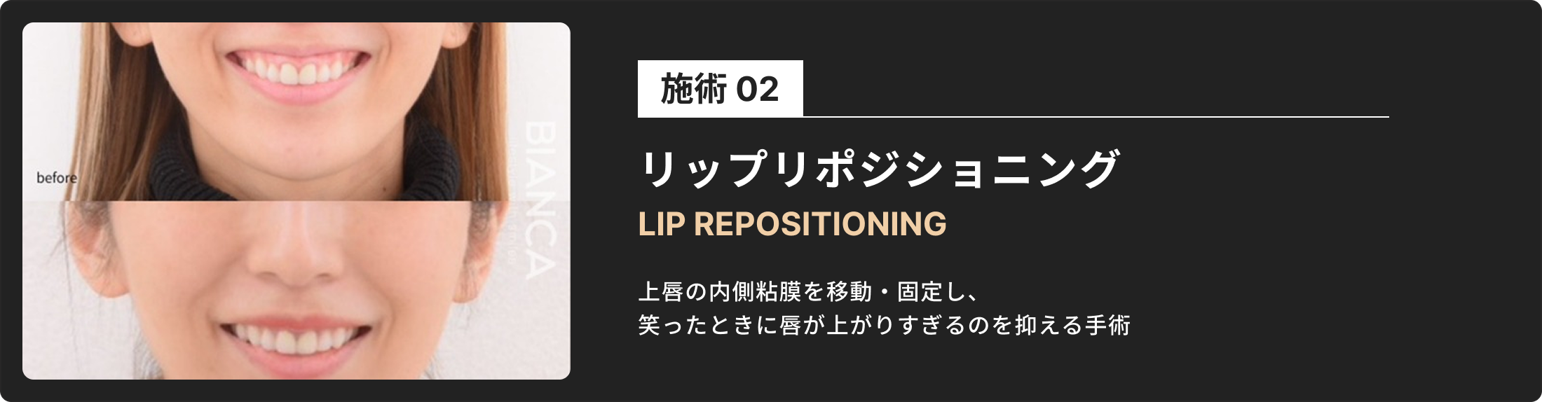 ガミースマイル治療
