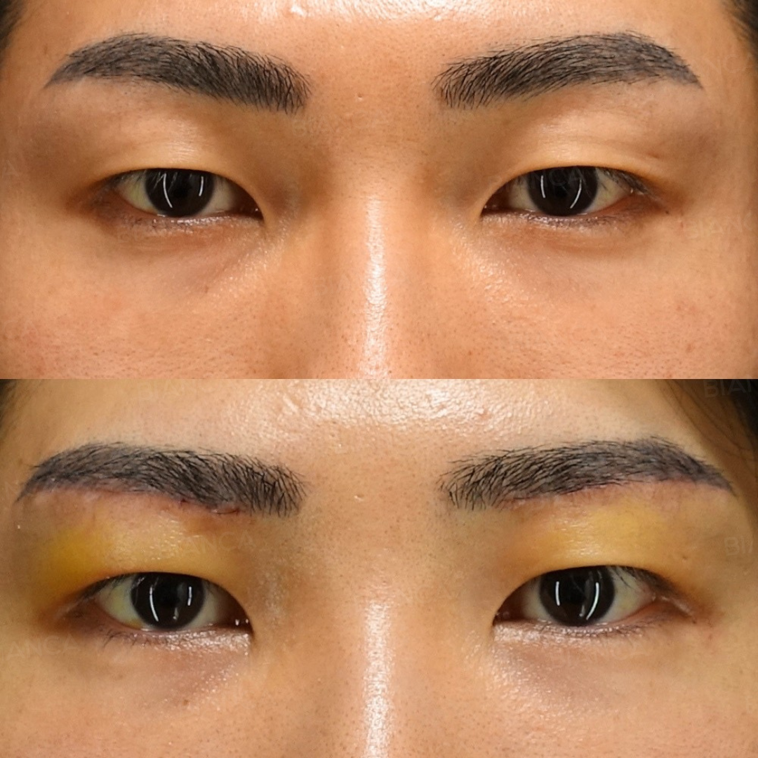 眉下切開