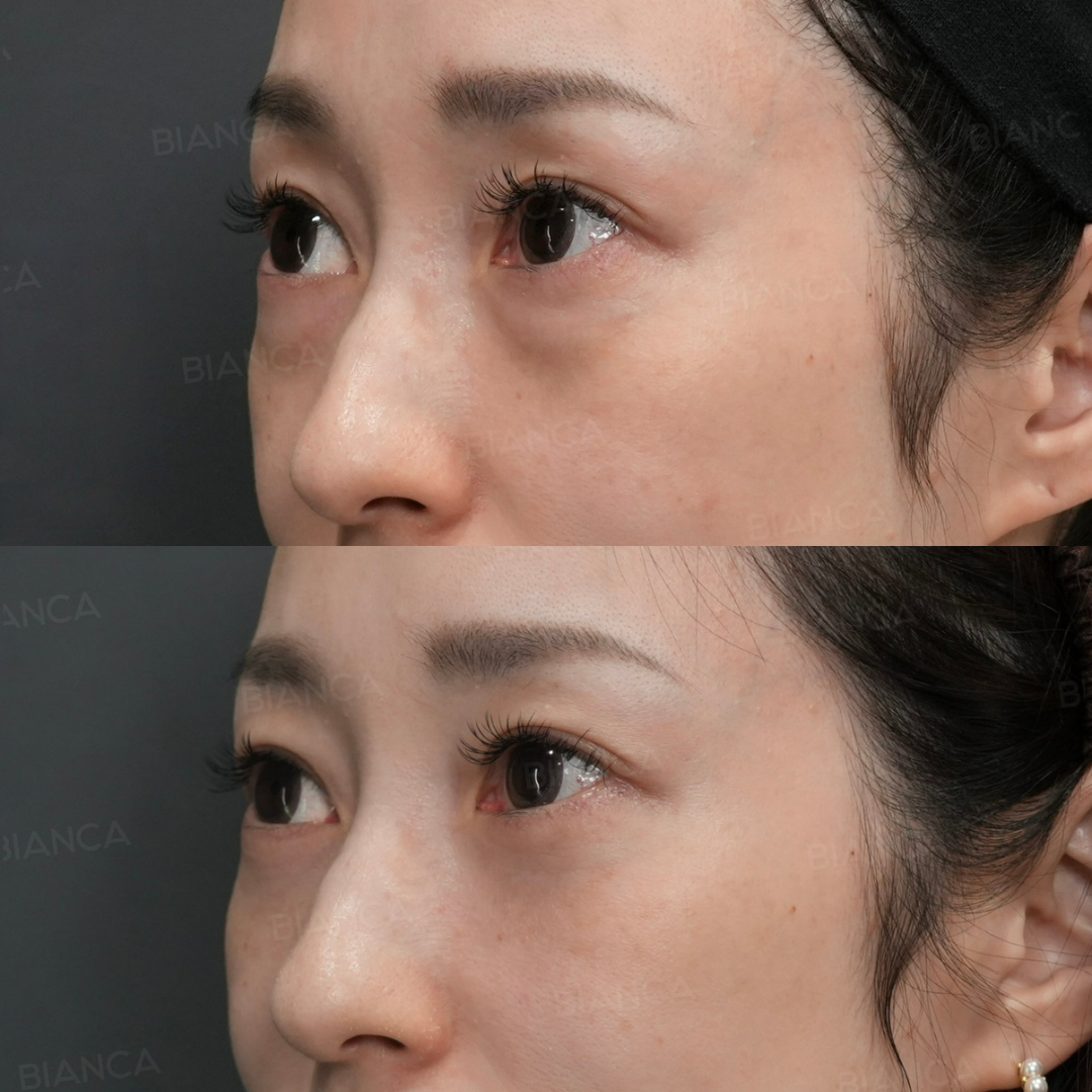裏ハムラ法