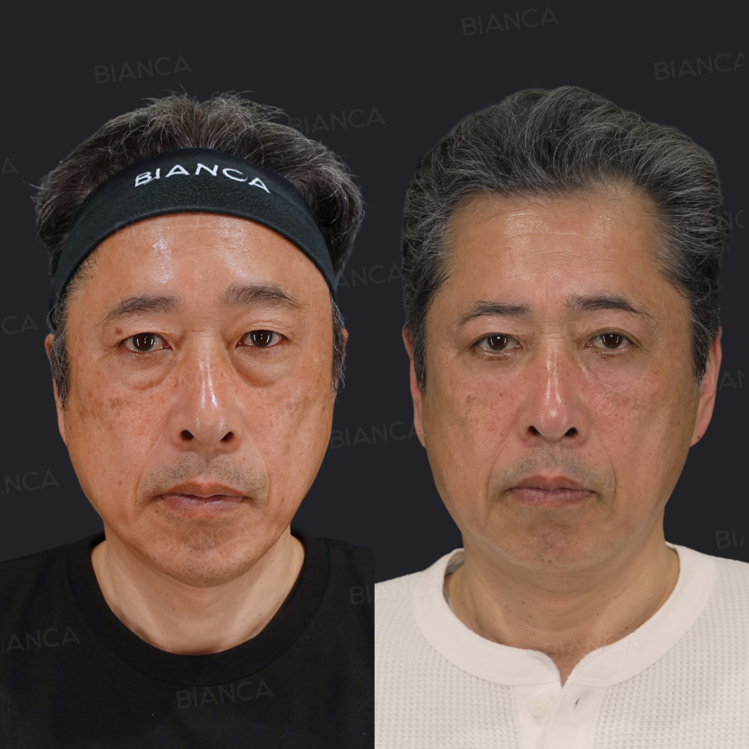 眉下切開、ピコスポット(シミ取り)、ハムラ法