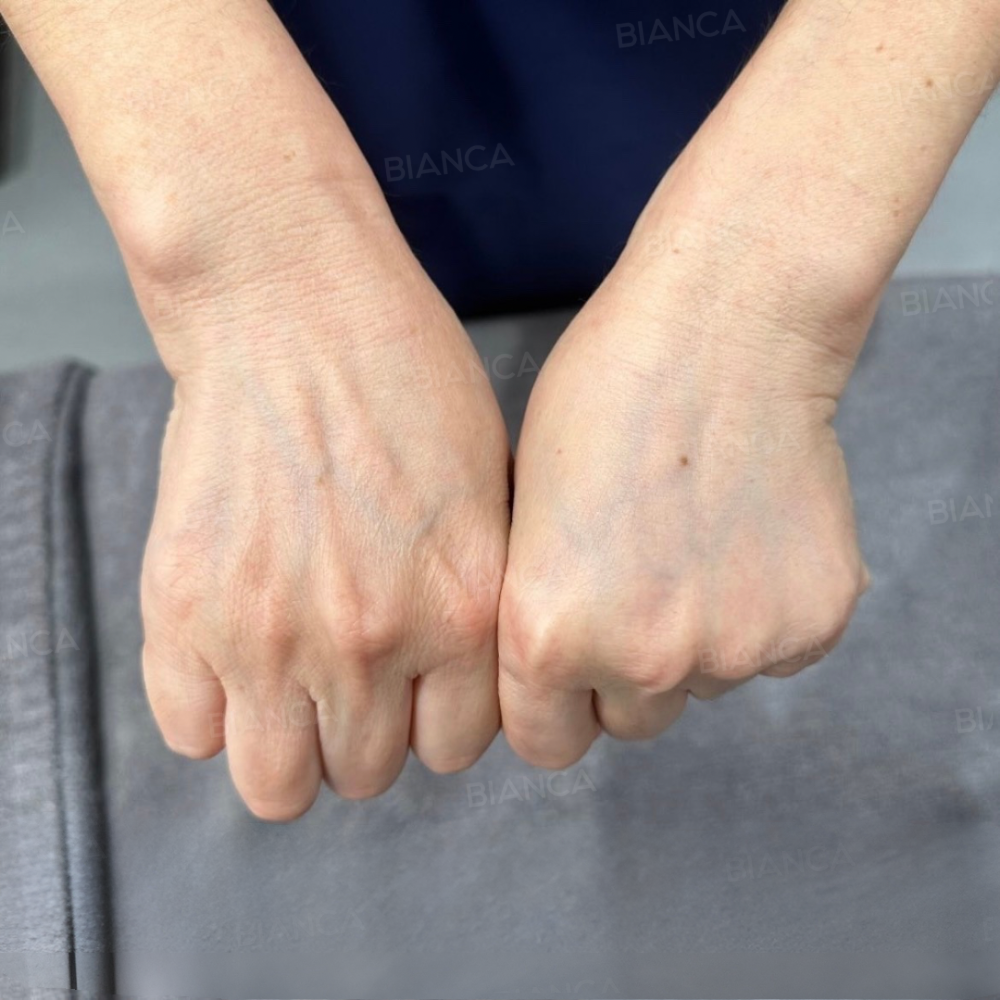 GOURI（手の甲）