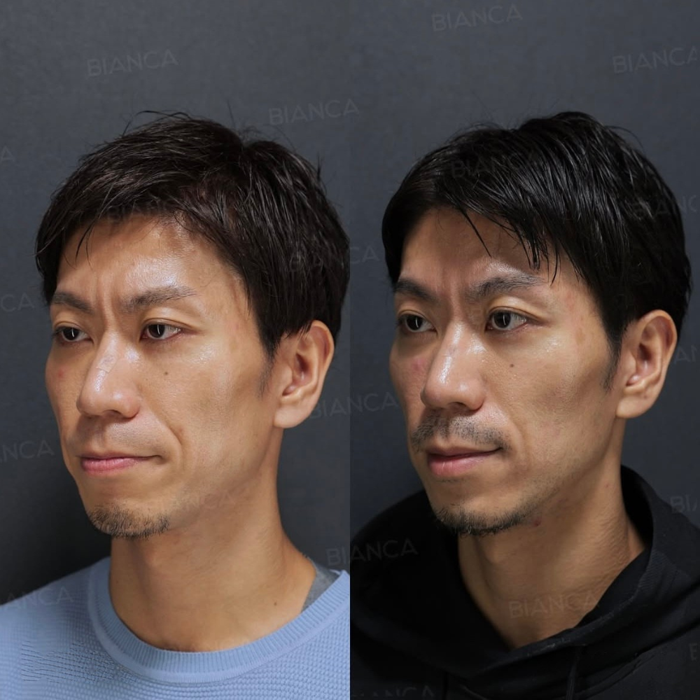 ボトックス注射（額・眉間・目周り・顎・エラ）