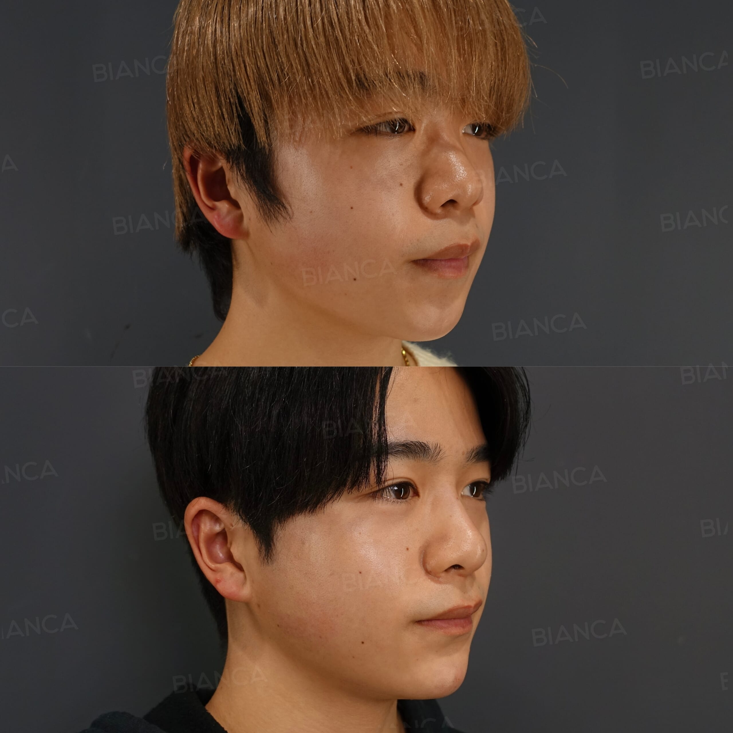 ヒアルロン酸注射(鼻先、顎)、ボトックス注射(エラ)