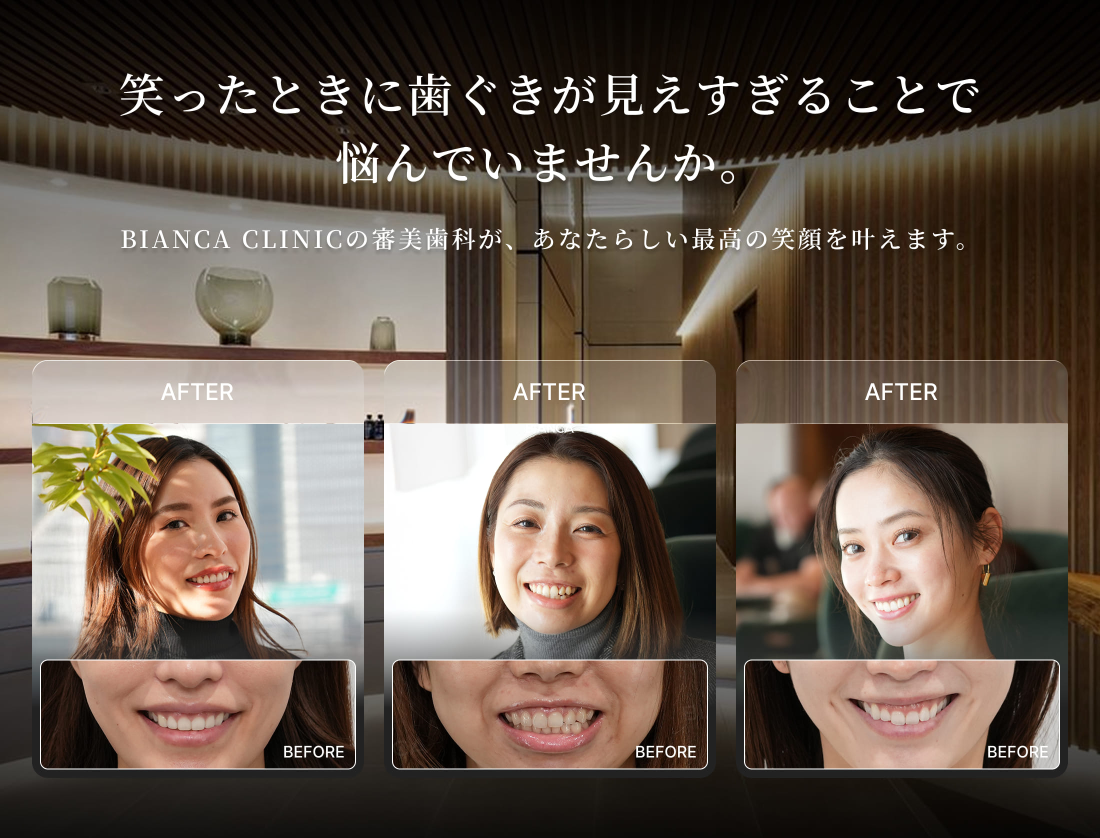 審美歯科　ガミースマイル